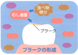 むし歯のはじまり